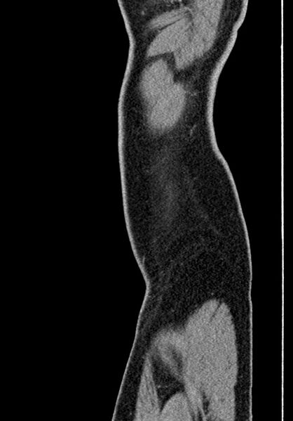 File:Adhesional small bowel obstruction (Radiopaedia 58900-66131 Sagittal C+ portal venous phase 246).jpg