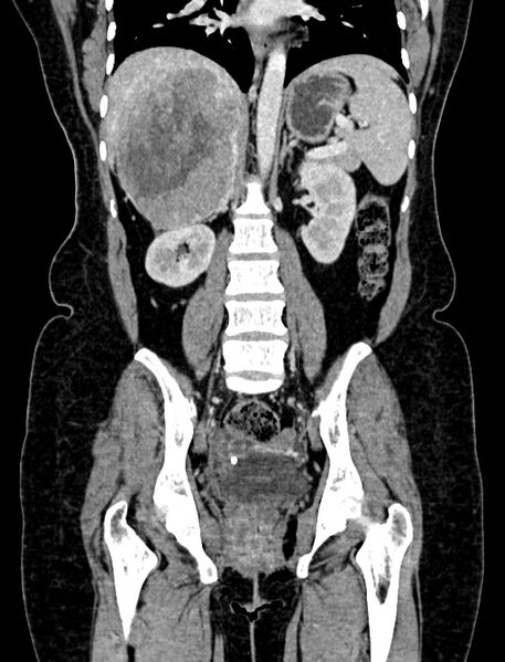 File:Adrenocortical carcinoma (Radiopaedia 87281-103569 Coronal C+ portal venous phase 73).jpg