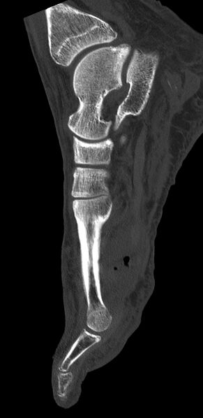 File:Advanced osteomyelitis due to open metatarsal fracture (Radiopaedia 83891-99095 C 10).jpg
