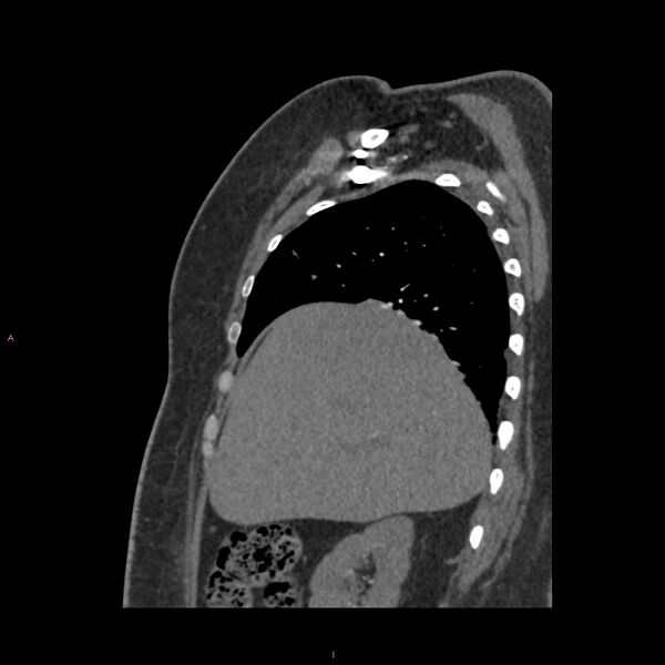 File:Agenesis of the left hepatic lobe (Radiopaedia 77284-89359 Sagittal C+ CTPA 27).jpg