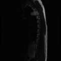 Aggressive vertebral hemangioma (Radiopaedia 39937-42404 Sagittal T2 1).png
