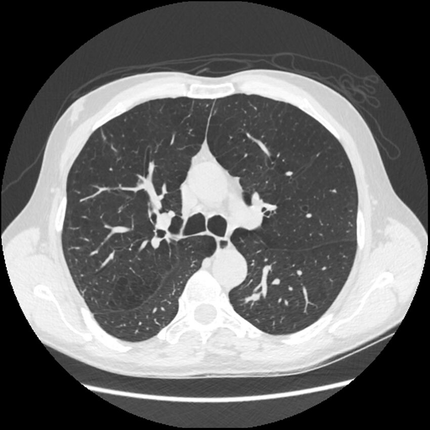 Alpha-1-antitrypsin deficiency (Radiopaedia 40993-43722 Axial lung window 90).jpg