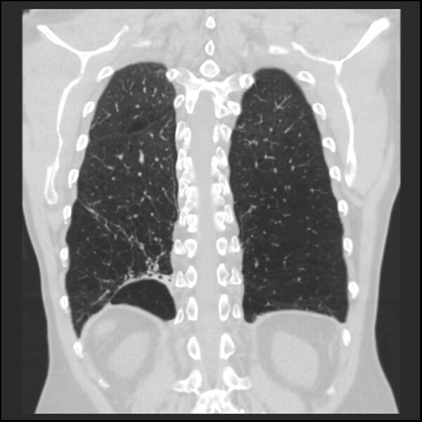 File:Alpha-1-antitrypsin deficiency (Radiopaedia 40993-43722 Coronal lung window 85).jpg