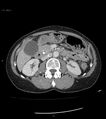 Ampulla of Vater metastasis (Radiopaedia 27820-28069 A 70).jpg
