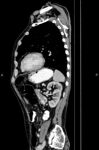 File:Ampullary adenocarcinoma (Radiopaedia 86093-102033 E 67).jpg
