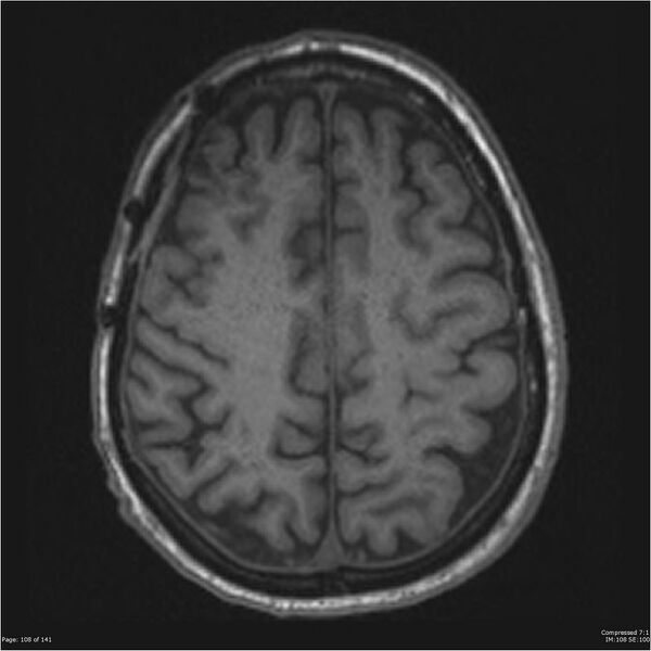 File:Anaplastic meningioma with recurrence (Radiopaedia 34452-35788 Axial T1 106).jpg