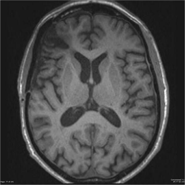 File:Anaplastic meningioma with recurrence (Radiopaedia 34452-35788 Axial T1 75).jpg