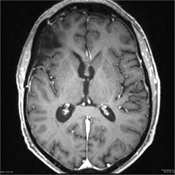File:Anaplastic meningioma with recurrence (Radiopaedia 34452-35788 Axial T1 C+ 76).jpg