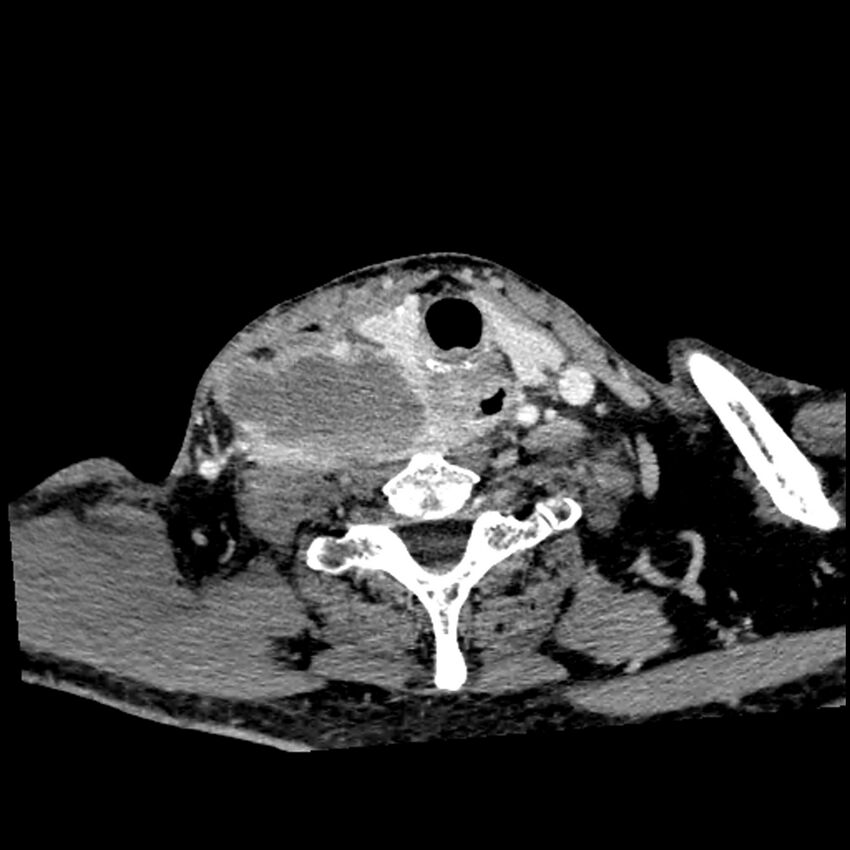 Anaplastic thyroid carcinoma (Radiopaedia 79087-92034 B 44).jpg