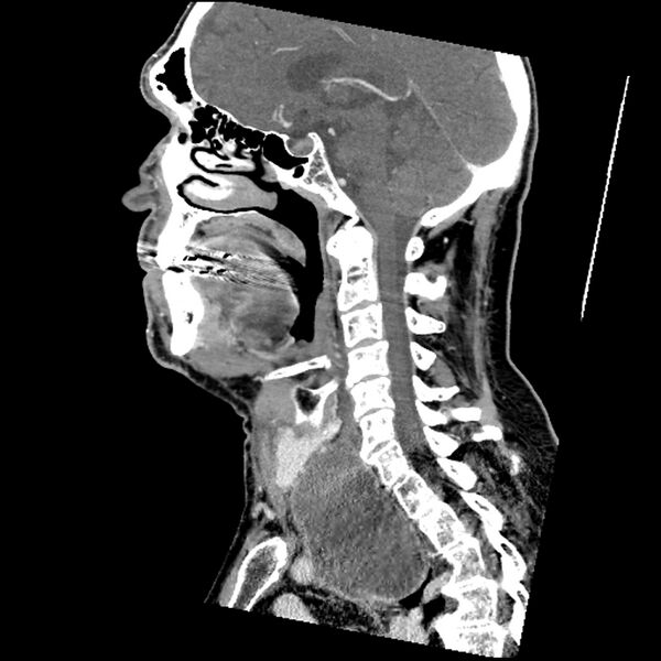 File:Anaplastic thyroid carcinoma (Radiopaedia 79087-92034 C 45).jpg
