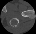Aneurysmal bone cyst of ischium (Radiopaedia 25957-26094 B 31).png
