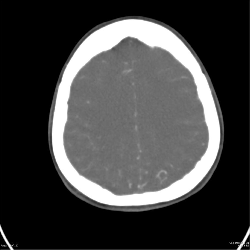 Aneurysmal subarachnoid hemorrhage and Moya Moya disease (Radiopaedia 34306-35593 Axial CT COW 15).jpg