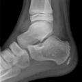 Ankle joint effusion (Radiopaedia 10534-10999 Lateral 1).png