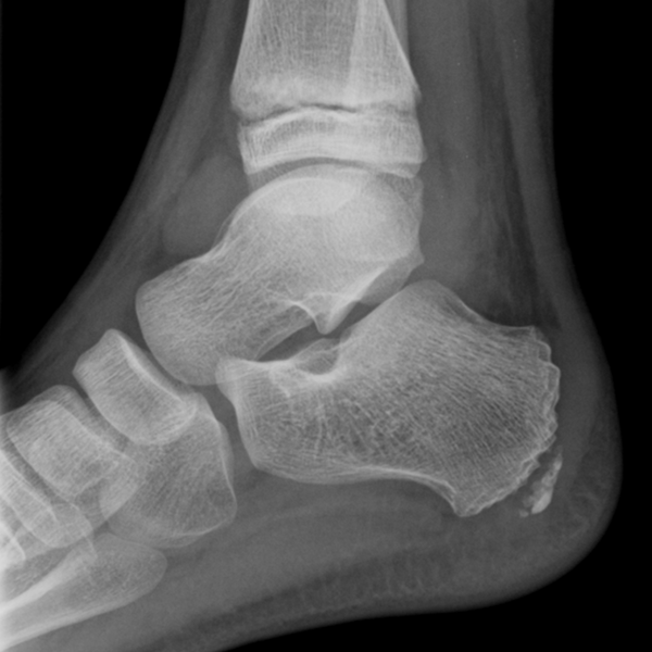 File:Ankle joint effusion (Radiopaedia 10534-10999 Lateral 1).png
