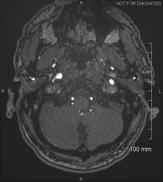 File:Anterior cerebral artery aneurysm (Radiopaedia 80683-94127 Axial MRA 18).jpg
