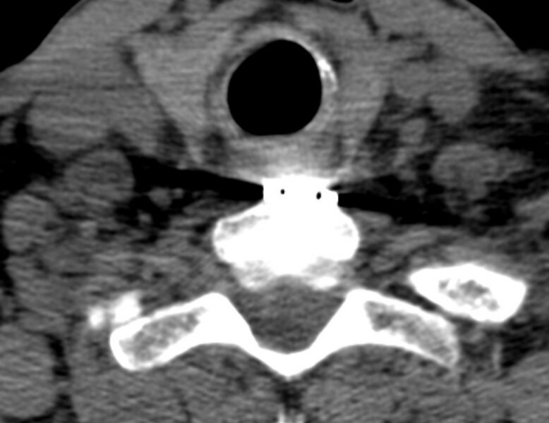 File:Anterior cervical postdiscectomy arthrodesis (Radiopaedia 32678-33646 Axial non-contrast 63).jpg