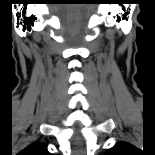 File:Anterior cervical postdiscectomy arthrodesis (Radiopaedia 32678-33646 Coronal non-contrast 24).jpg