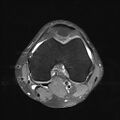 Anterior cruciate ligament full thickness tear (Radiopaedia 66268-75467 Axial PD fat sat 13).jpg