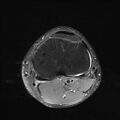 Anterior cruciate ligament full thickness tear (Radiopaedia 66268-75467 Axial PD fat sat 21).jpg