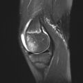 Anterior cruciate ligament tear - pediatric (Radiopaedia 62152-70260 Sagittal PD fat sat 11).jpg