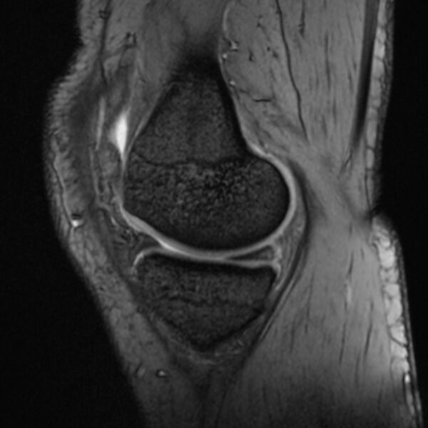 File:Anterior cruciate ligament tear - ramp lesion (Radiopaedia 71883-82322 Sagittal T2 fat sat 18).jpg
