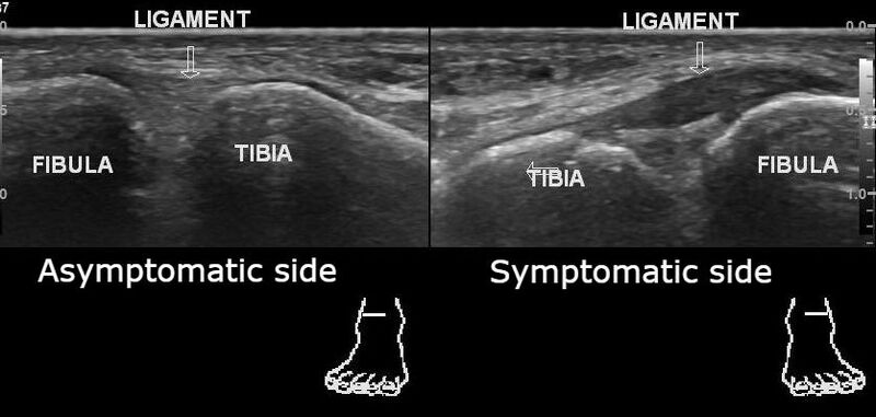 File:Anterior inferior tibiofibular ligament injury (Radiopaedia 65077-74073 B 1).jpg