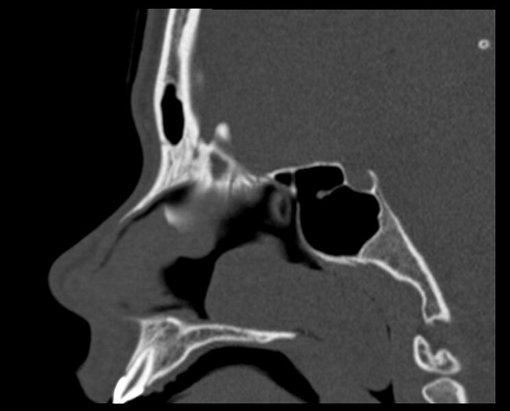 File:Antrochoanal polyp (Radiopaedia 21894-21868 Sagittal bone window 19).jpg