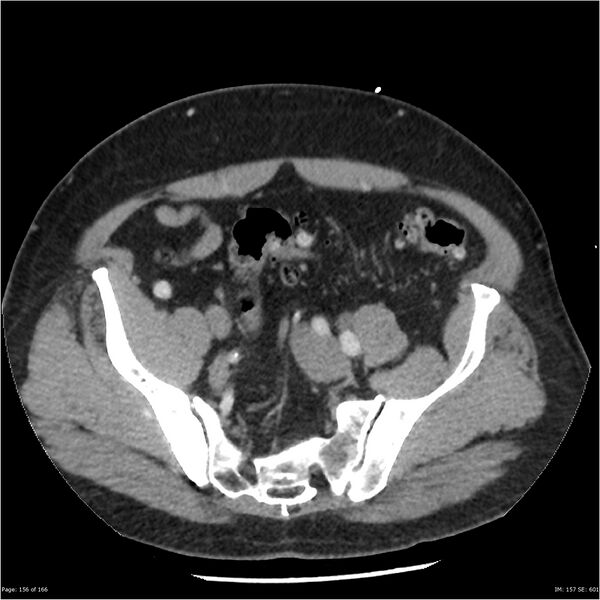File:Aortic dissection- Stanford A (Radiopaedia 37759-39664 A 147).jpg