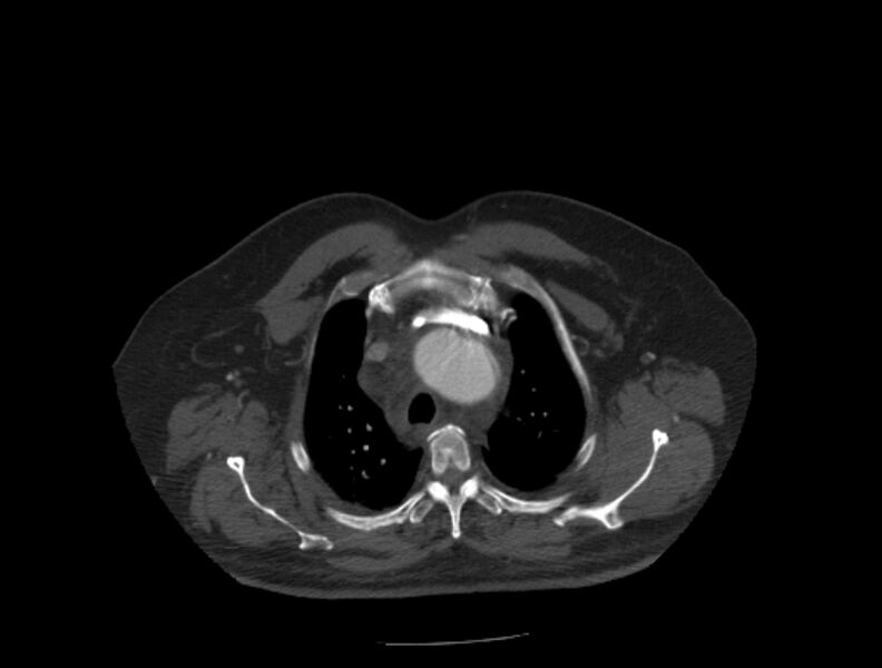 File:Aortic dissection (Radiopaedia 28802-29105 A 3).jpg
