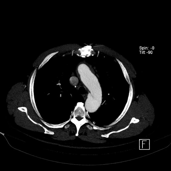 File:Aortic dissection - De Bakey type III - Stanford B (Radiopaedia 21903-21882 B 18).jpg