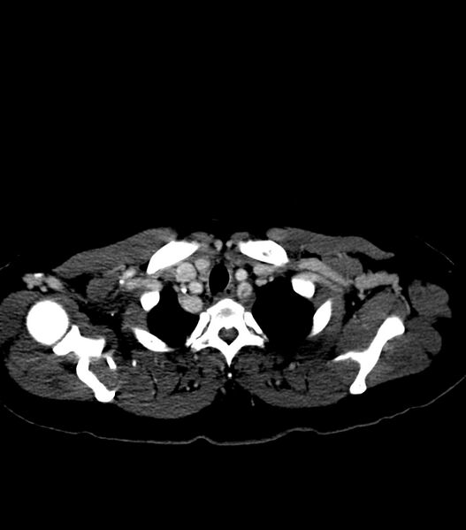 File:Aortic dissection with renal ischemia (Radiopaedia 76573-88338 B 3).jpg