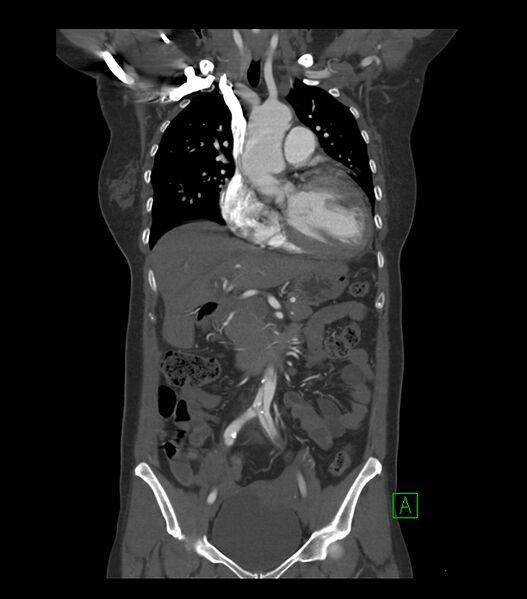 File:Aortic dissection with renal ischemia (Radiopaedia 76573-88338 C 6).jpg