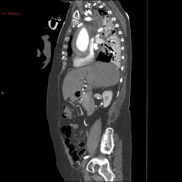 File:Aortic intramural hematoma (Radiopaedia 27746-28001 C 15).jpg