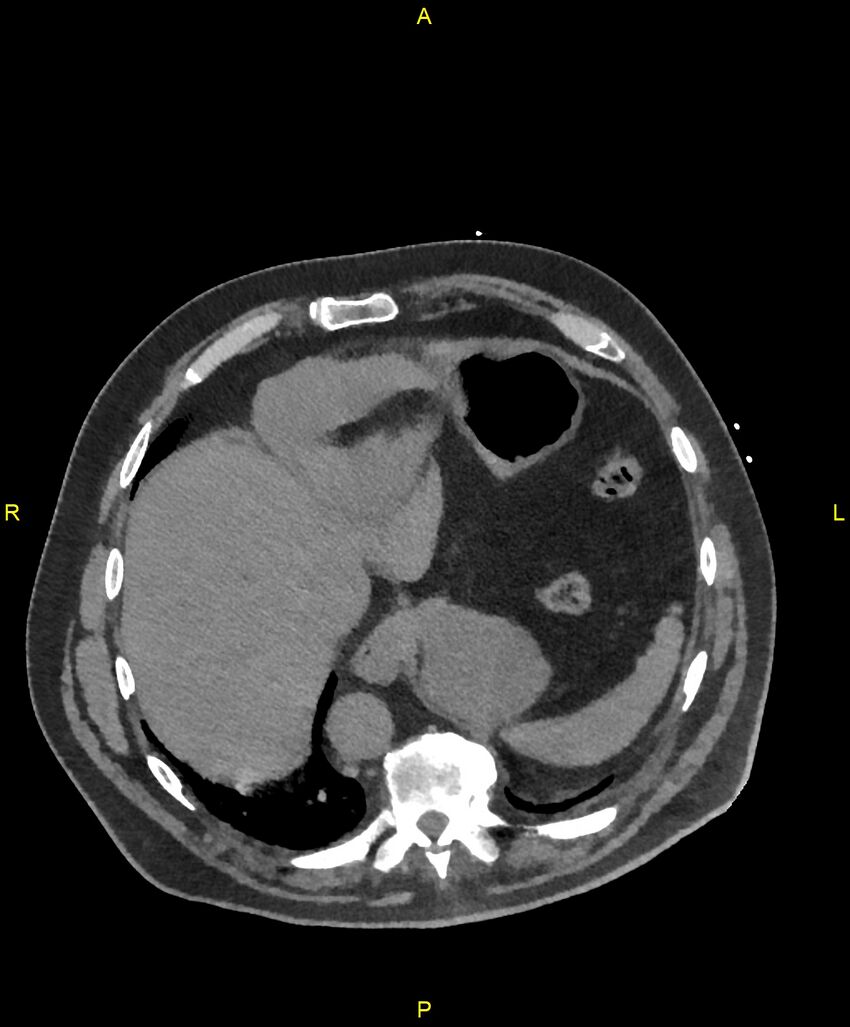 Aortic rupture (Radiopaedia 88822-105594 Axial non-contrast 200).jpg