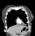 Aortic valve non-coronary cusp thrombus (Radiopaedia 55661-62189 C 15).png