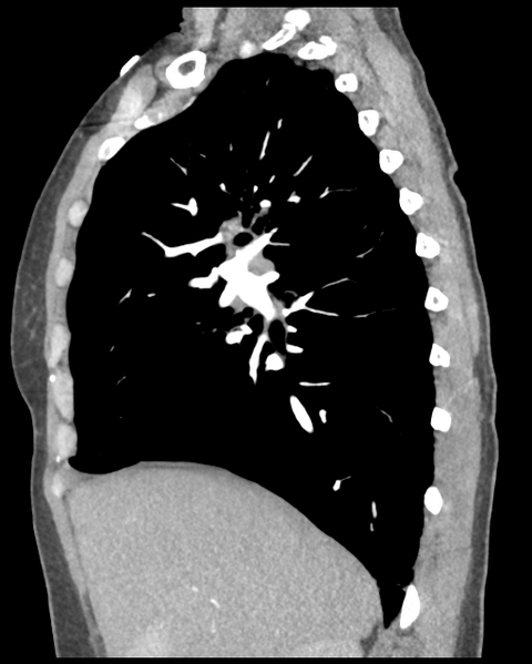 File:Aortic valve non-coronary cusp thrombus (Radiopaedia 55661-62189 D 35).png