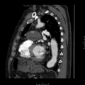 Aorto-coronary bypass graft aneurysms (Radiopaedia 40562-43157 C 26).png