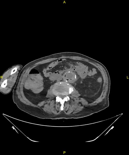 File:Aortoenteric fistula (Radiopaedia 84308-99603 Axial non-contrast 195).jpg