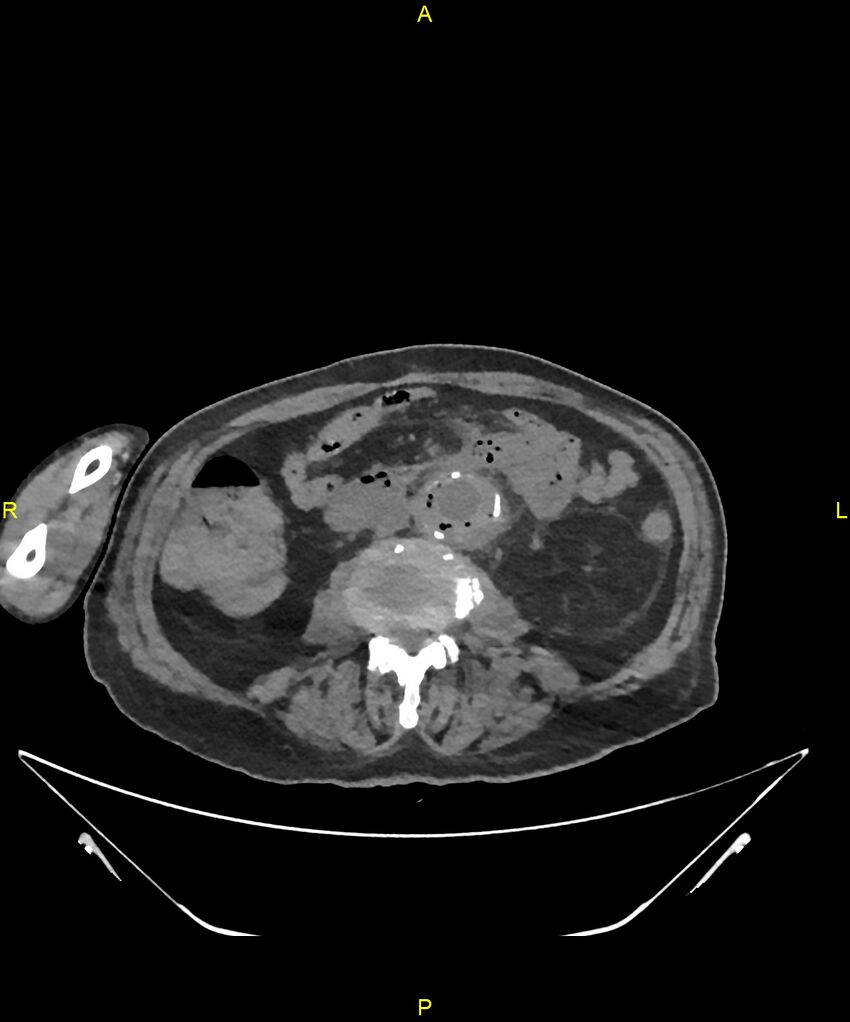 Aortoenteric fistula (Radiopaedia 84308-99603 Axial non-contrast 195).jpg