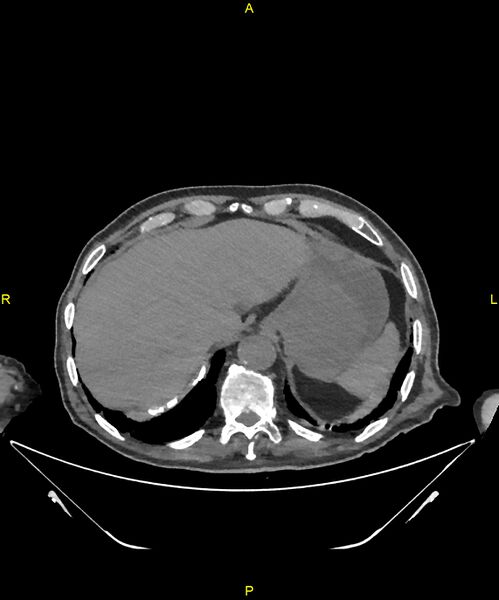 File:Aortoenteric fistula (Radiopaedia 84308-99603 Axial non-contrast 40).jpg
