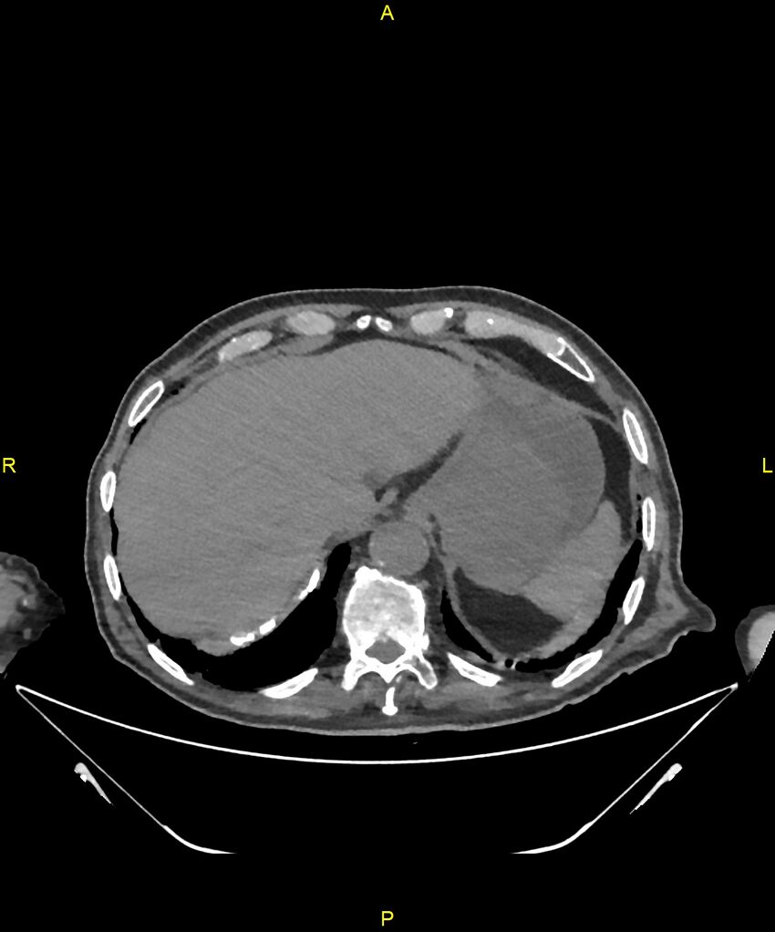 Aortoenteric fistula (Radiopaedia 84308-99603 Axial non-contrast 40).jpg