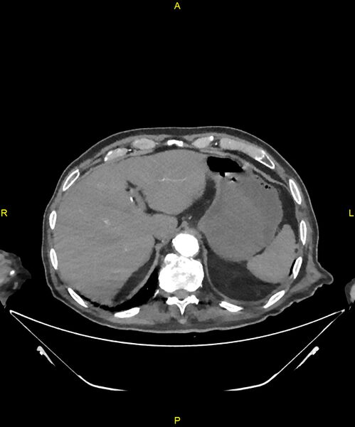 File:Aortoenteric fistula (Radiopaedia 84308-99603 B 49).jpg