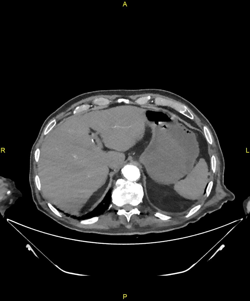 Aortoenteric fistula (Radiopaedia 84308-99603 B 49).jpg