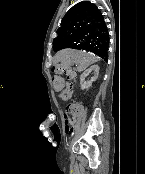 File:Aortoenteric fistula (Radiopaedia 84308-99603 C 106).jpg