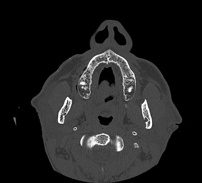 File:Aplastic maxillary sinuses (Radiopaedia 60030-67561 Axial non-contrast 2).jpg
