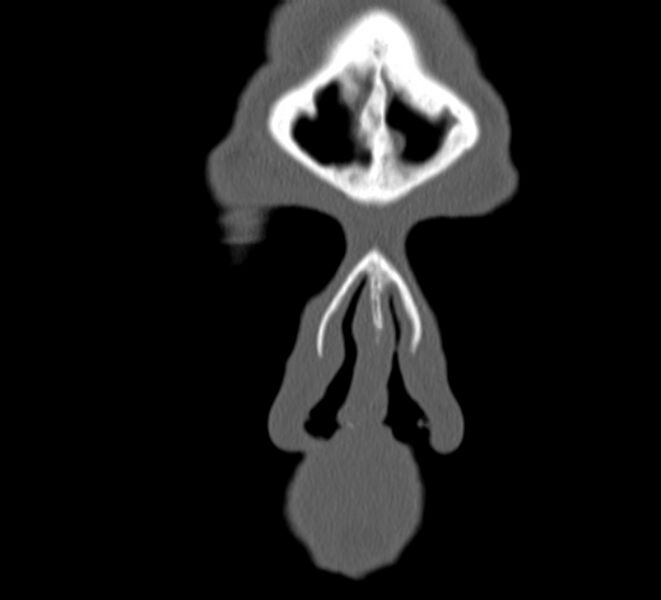File:Aplastic maxillary sinuses (Radiopaedia 60030-67561 Coronal non-contrast 3).jpg
