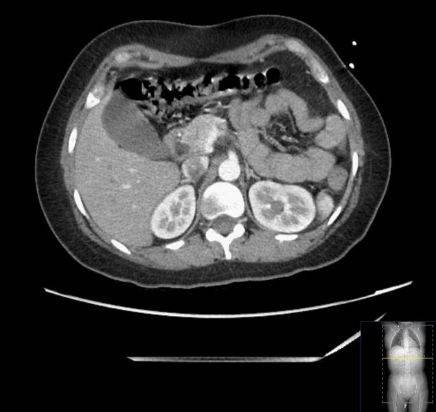 File:Appendicitis (CT angiogram) (Radiopaedia 154713-127660 Axial 143).jpg