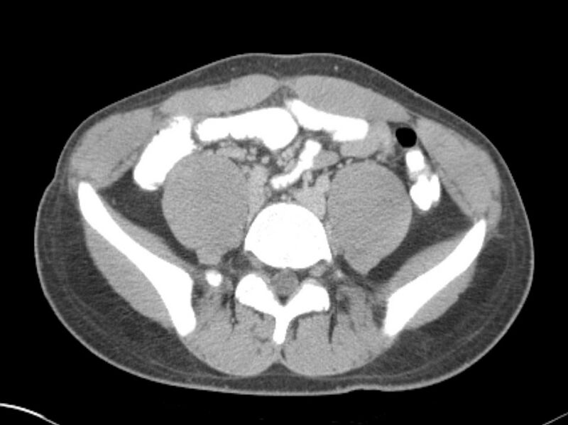 File:Appendicitis and incidental foregut duplication cyst (Radiopaedia 52962-58916 A 59).jpg