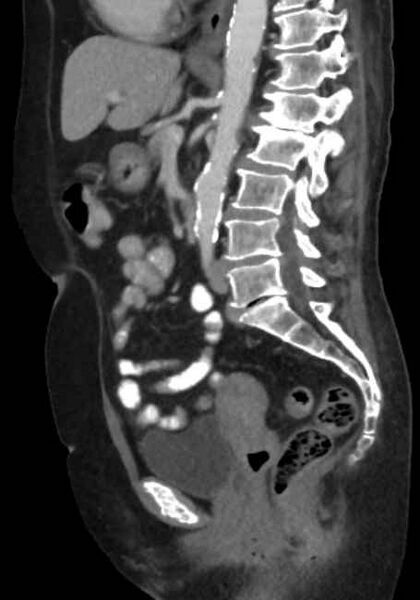 File:Appendicitis due to chicken fibula (Radiopaedia 74314-85198 C 52).jpg