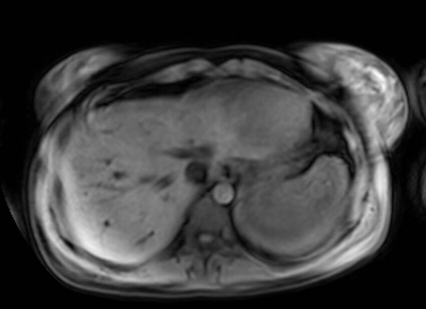 Appendicitis in gravida (MRI) (Radiopaedia 89433-106395 Axial DIXON 7).jpg